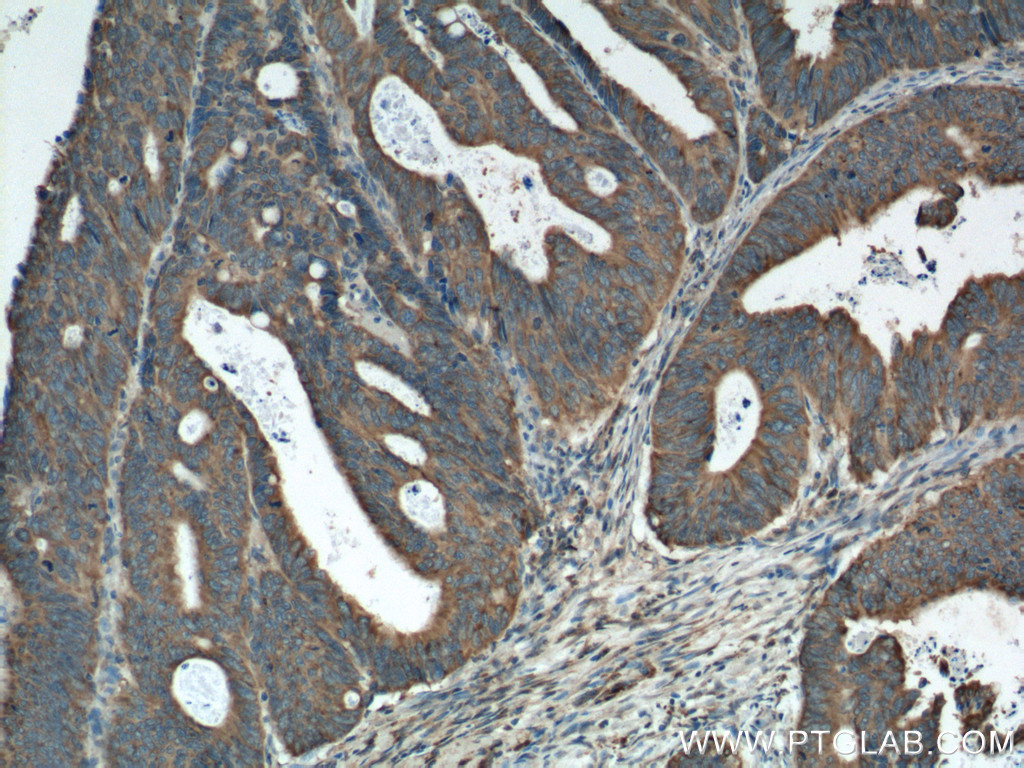 IHC staining of human colon cancer using 16036-1-AP