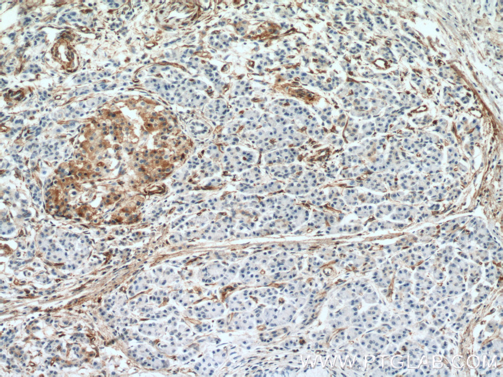 IHC staining of human pancreas cancer using 66433-1-Ig (same clone as 66433-1-PBS)