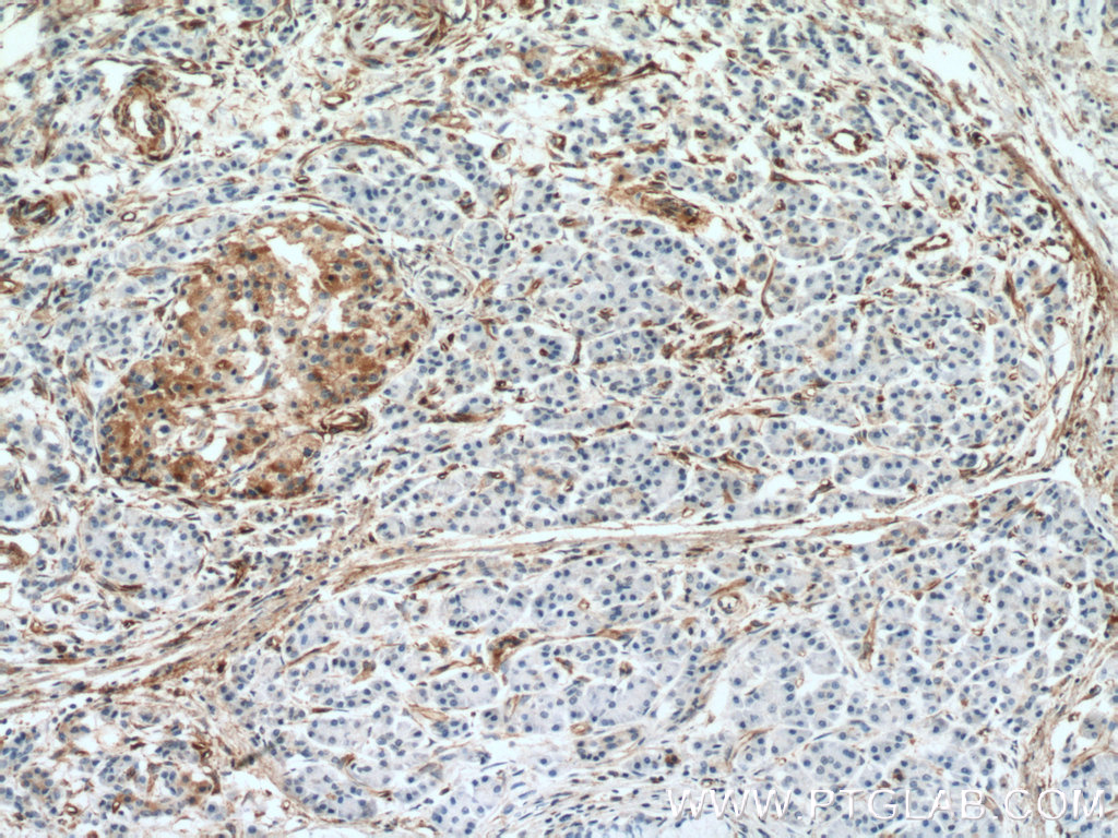 IHC staining of human pancreas cancer using 66433-1-Ig