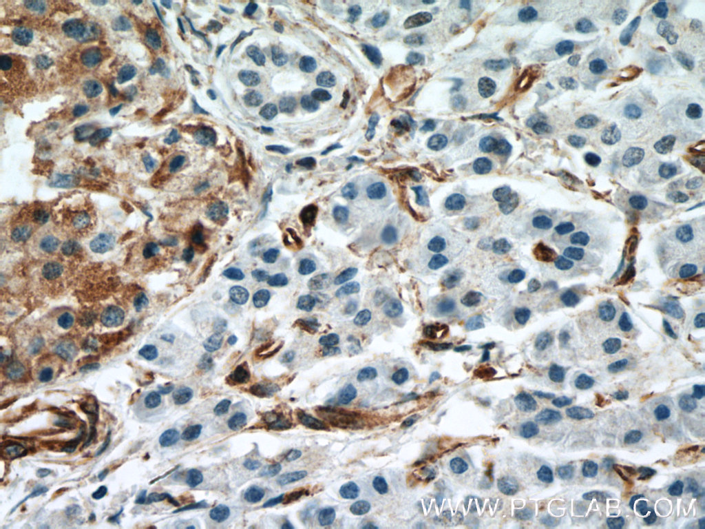 IHC staining of human pancreas cancer using 66433-1-Ig (same clone as 66433-1-PBS)