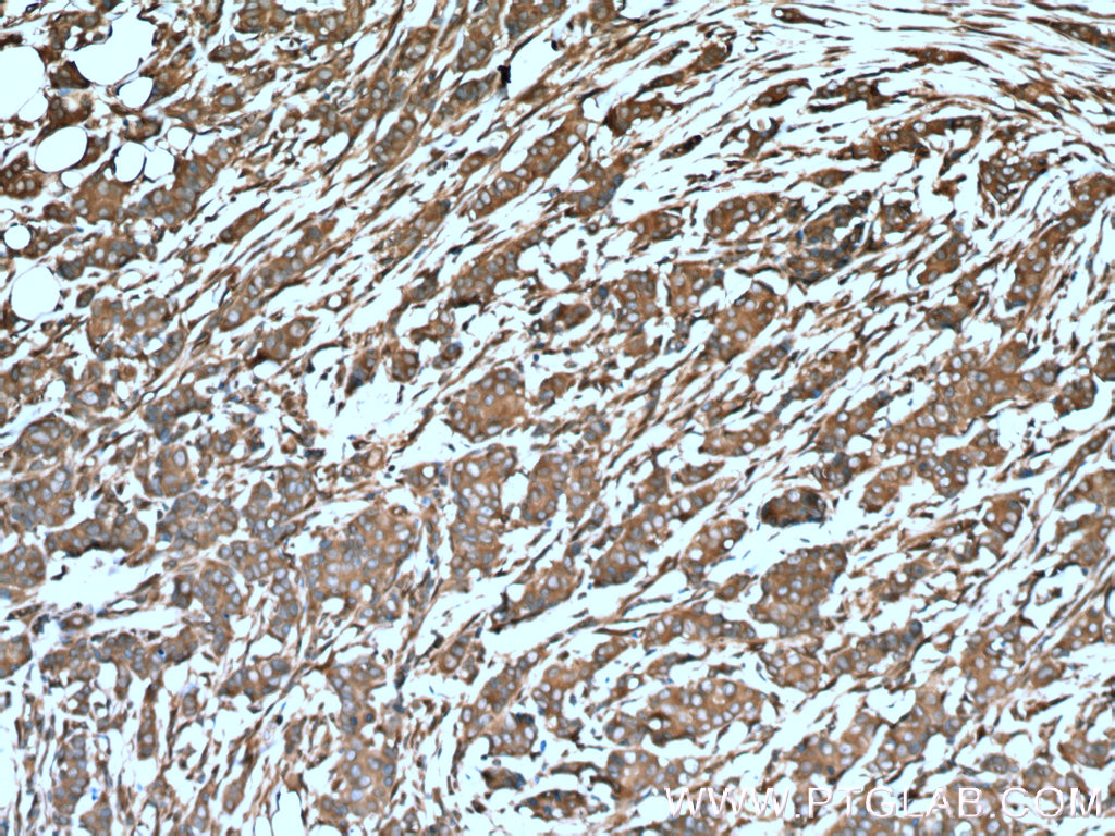 IHC staining of human breast cancer using 11673-1-AP