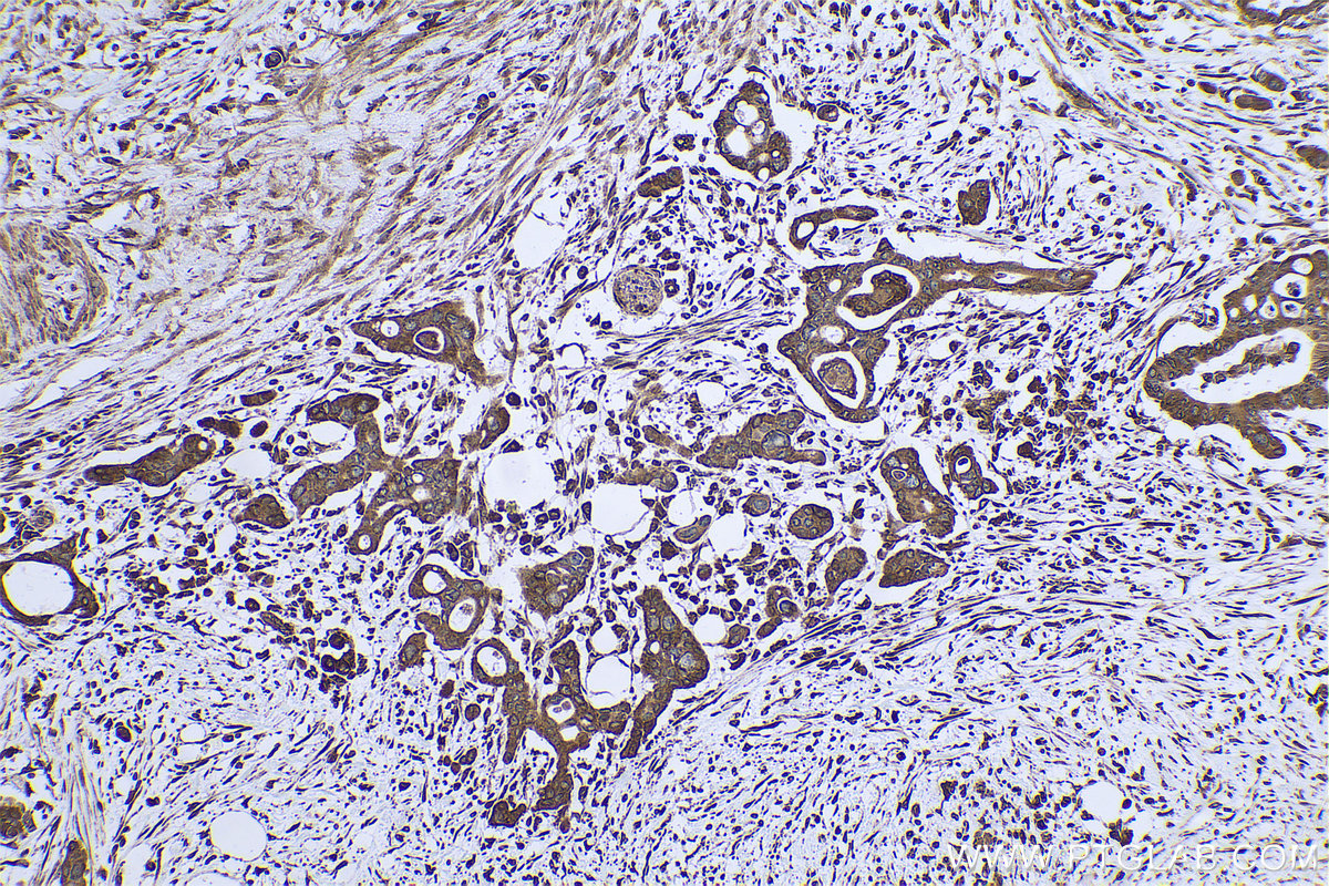 IHC staining of human pancreas cancer using 68204-1-Ig