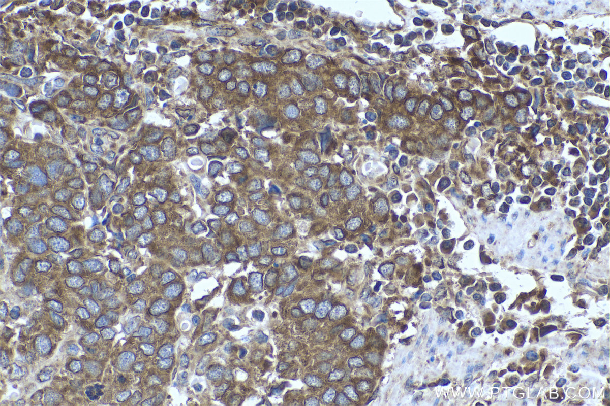 IHC staining of human stomach cancer using 68204-1-Ig