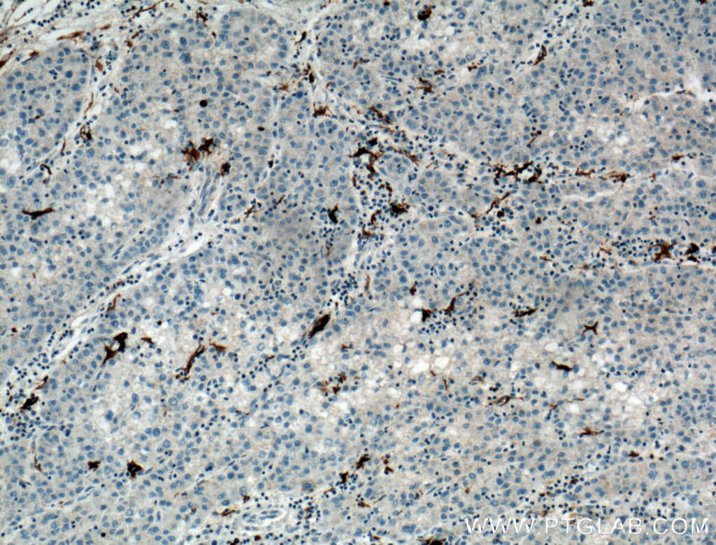 IHC staining of human liver cancer using 20225-1-AP