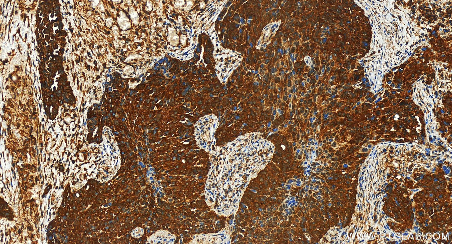 IHC staining of human ovary cancer using 31684-1-AP