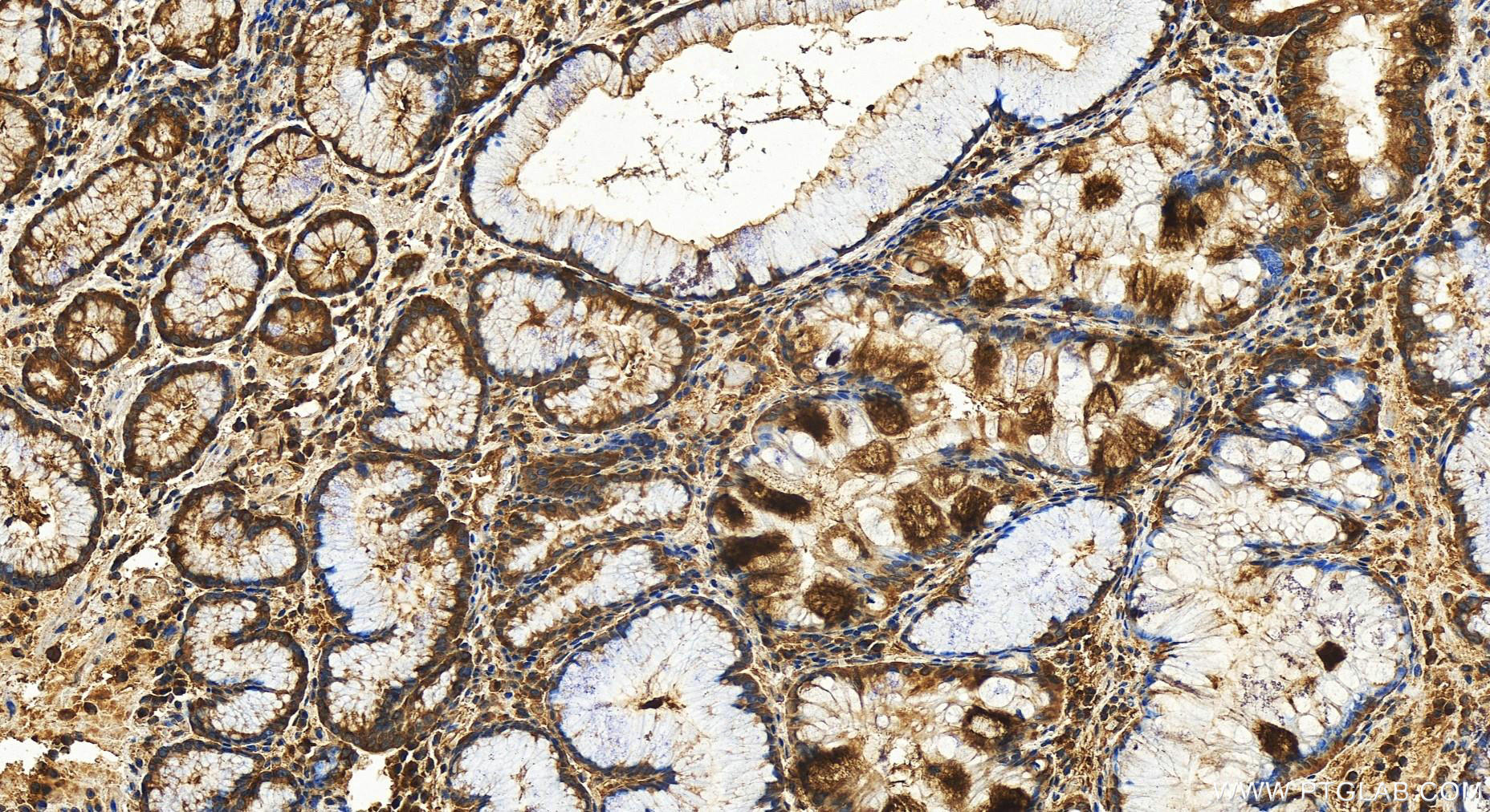 IHC staining of human stomach cancer using 31277-1-AP