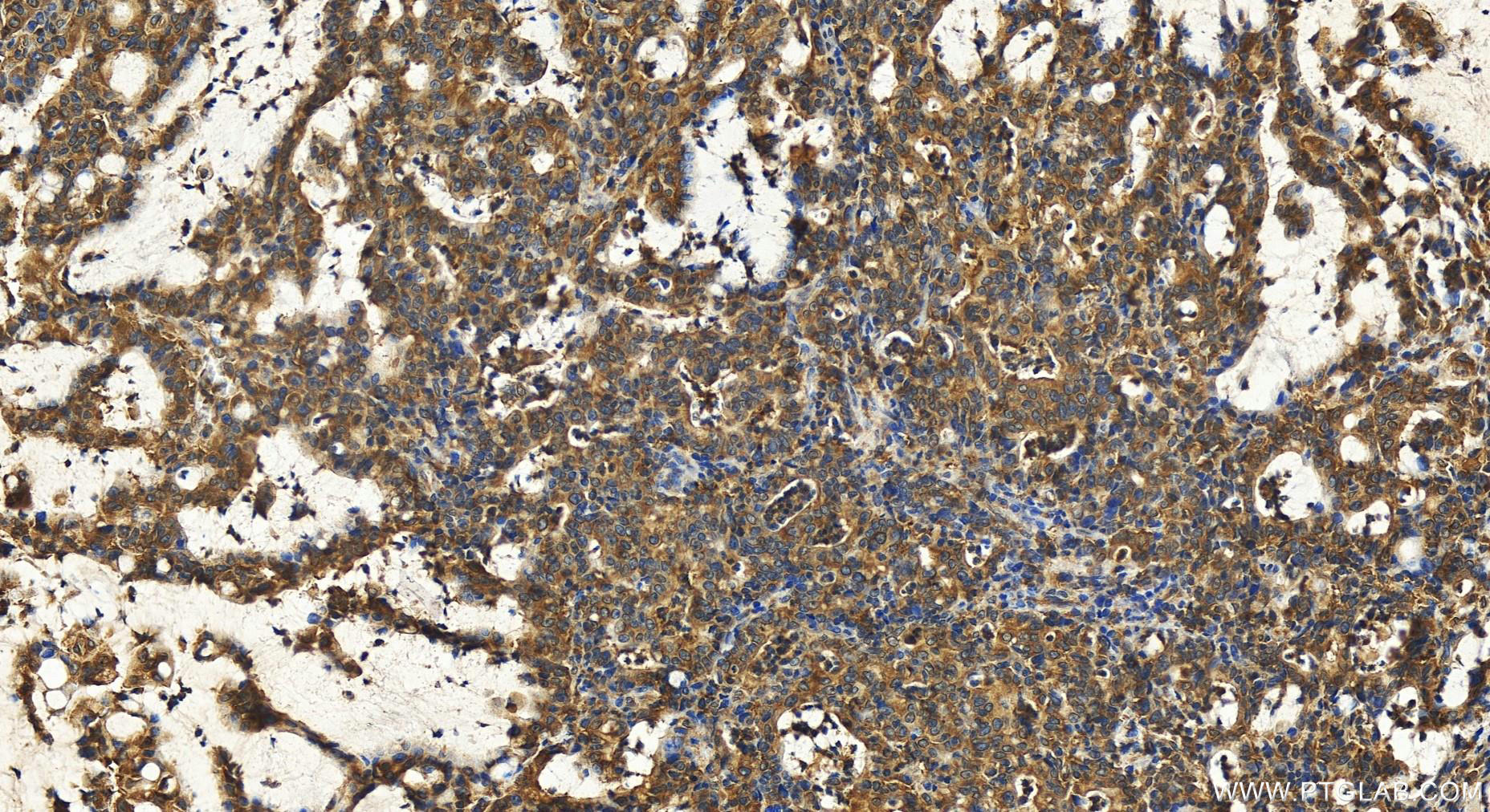 IHC staining of human stomach cancer using 31277-1-AP