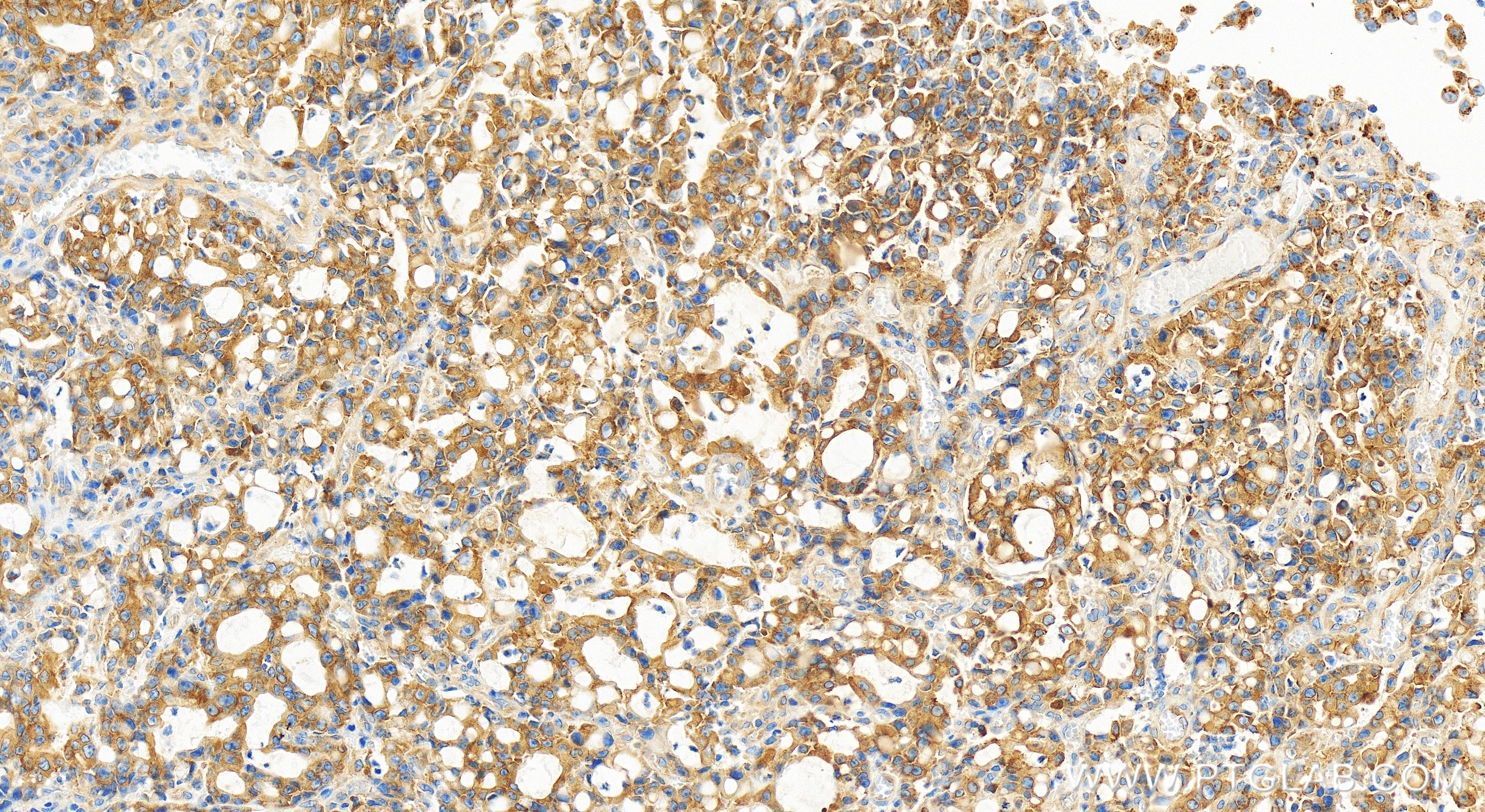 IHC staining of human stomach cancer using 84296-4-RR