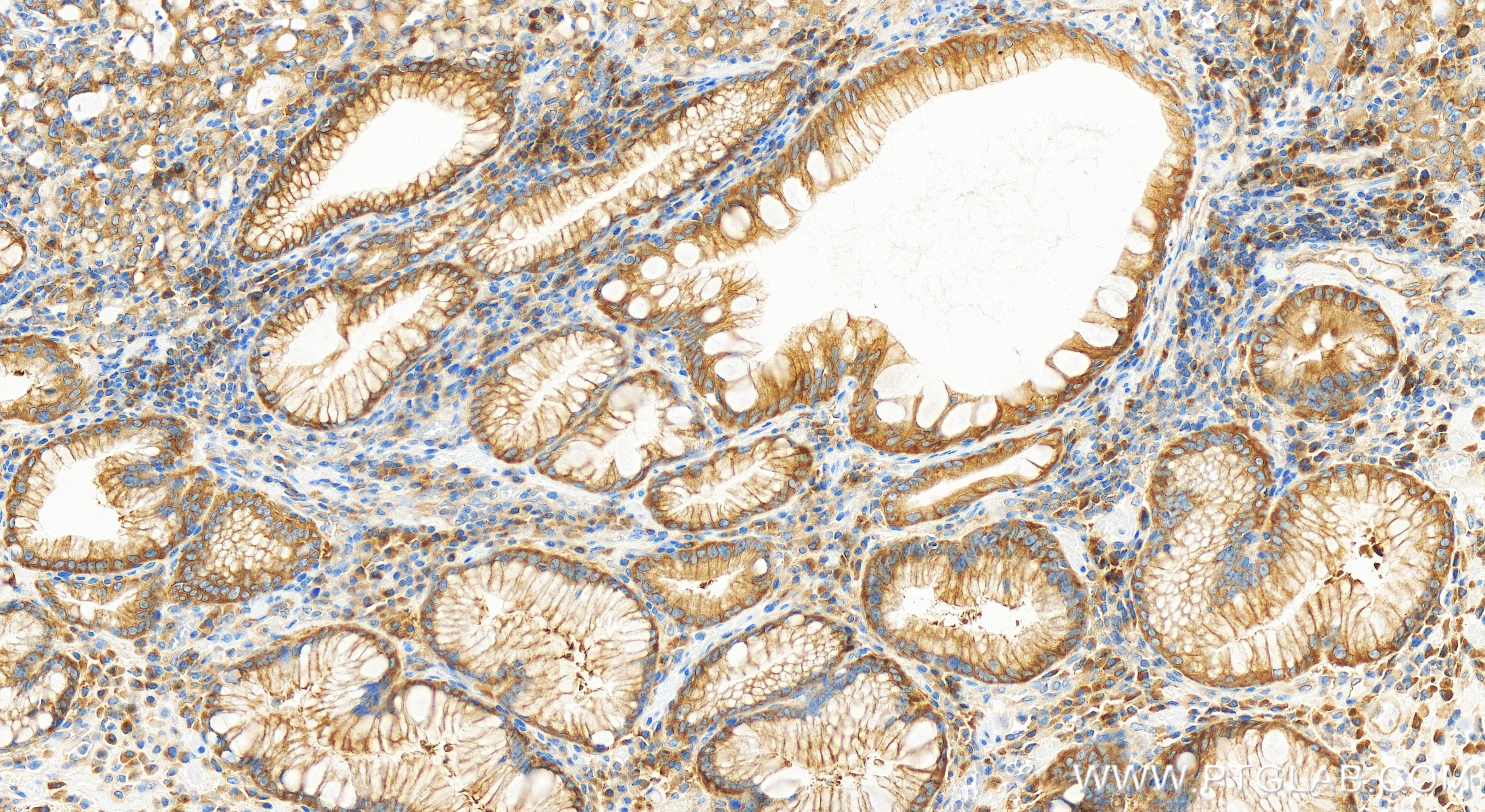 IHC staining of human stomach cancer using 84296-4-RR