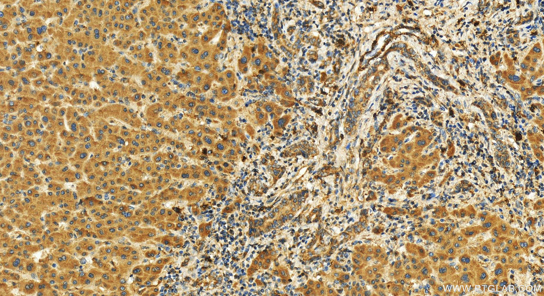 IHC staining of human intrahepatic cholangiocarcinoma using 17712-1-AP