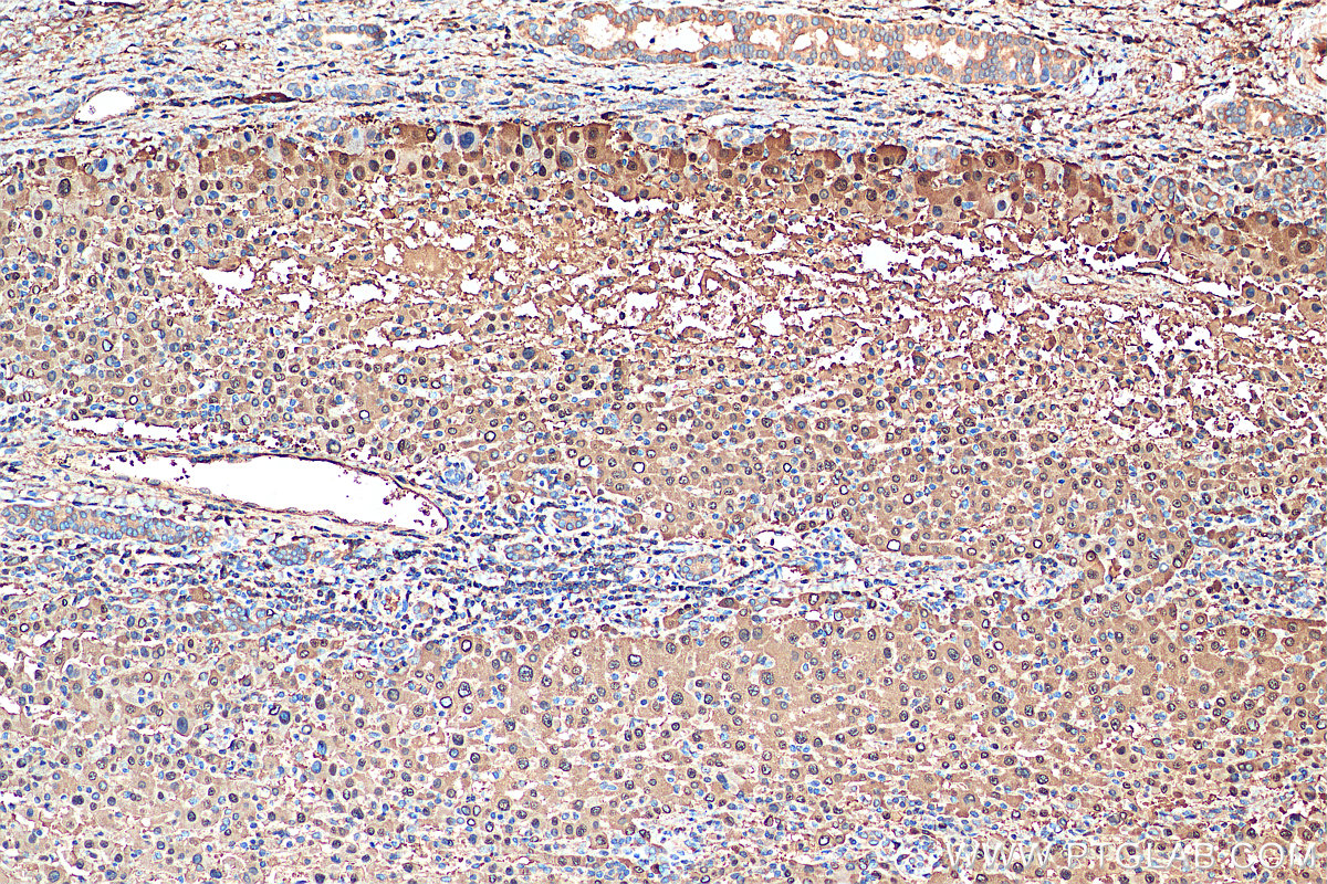 IHC staining of human liver cancer using 16001-1-AP