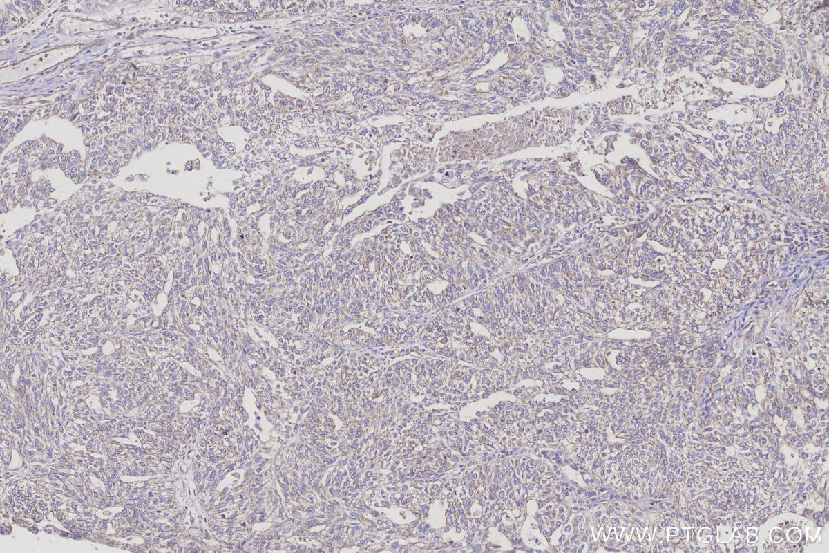 IHC staining of human ovary cancer using 31938-1-AP IHC staining of human ovary cancer using 31938-1-AP