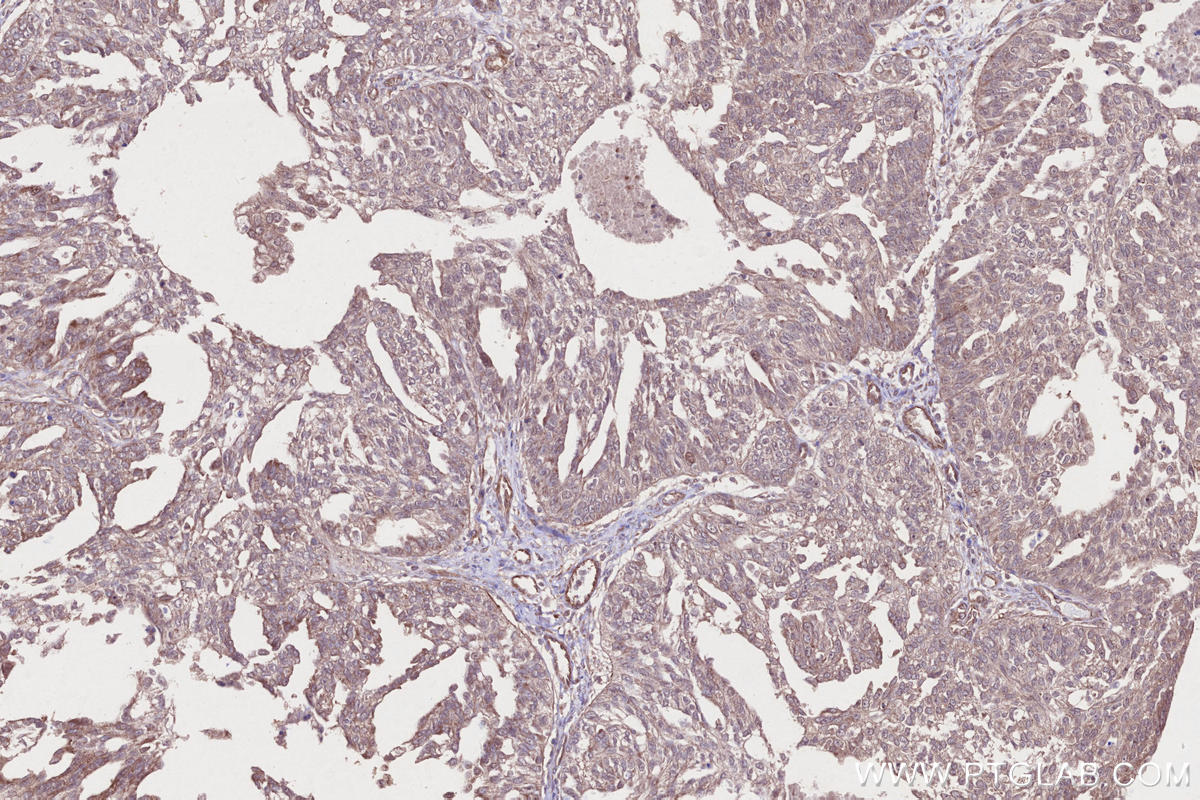IHC staining of human ovary cancer using 18834-1-AP IHC staining of human ovary cancer using 18834-1-AP