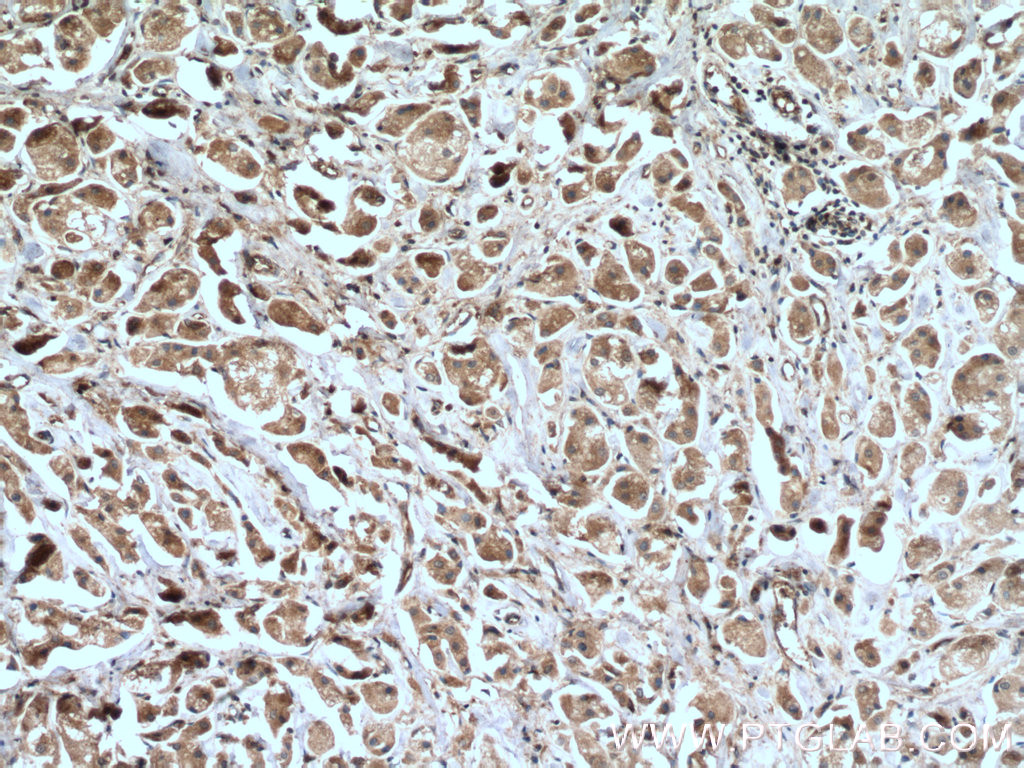 IHC staining of human breast cancer using 22077-1-AP