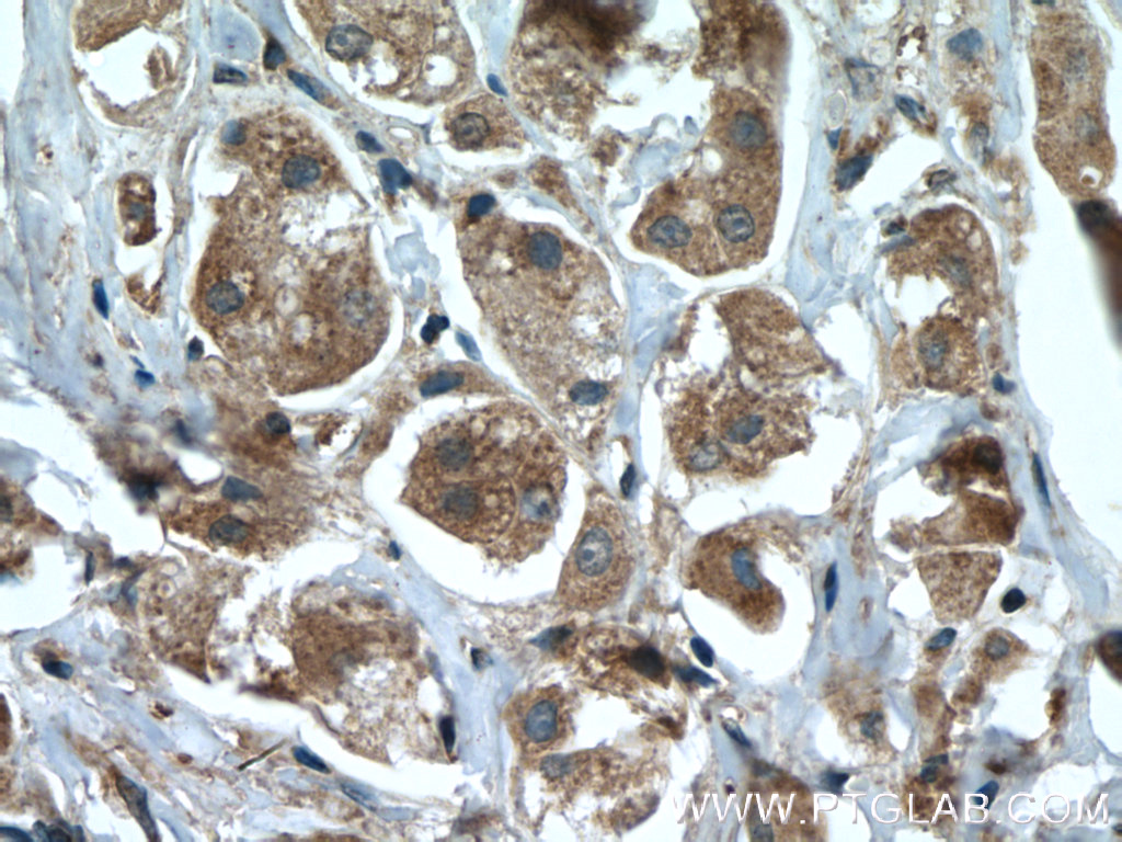 IHC staining of human breast cancer using 22077-1-AP