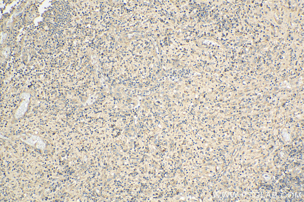 IHC staining of human colon cancer using 12583-1-AP