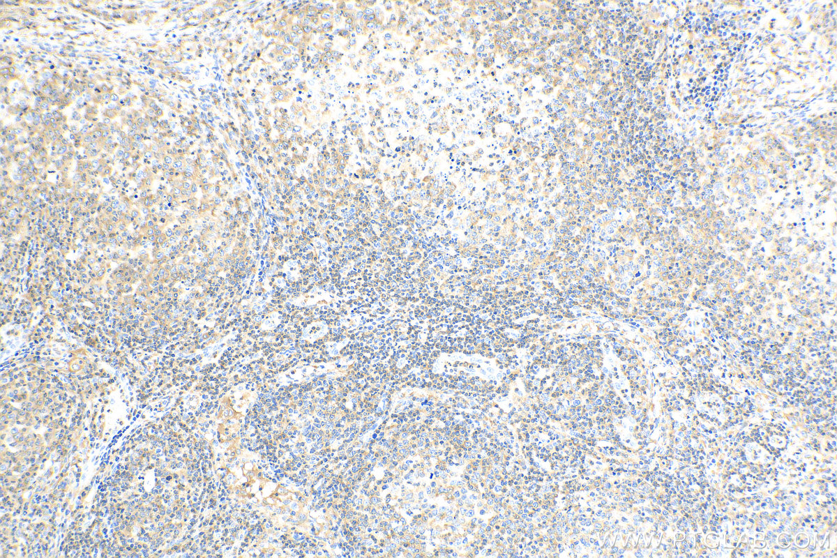 IHC staining of human lymphoma using 16697-1-AP