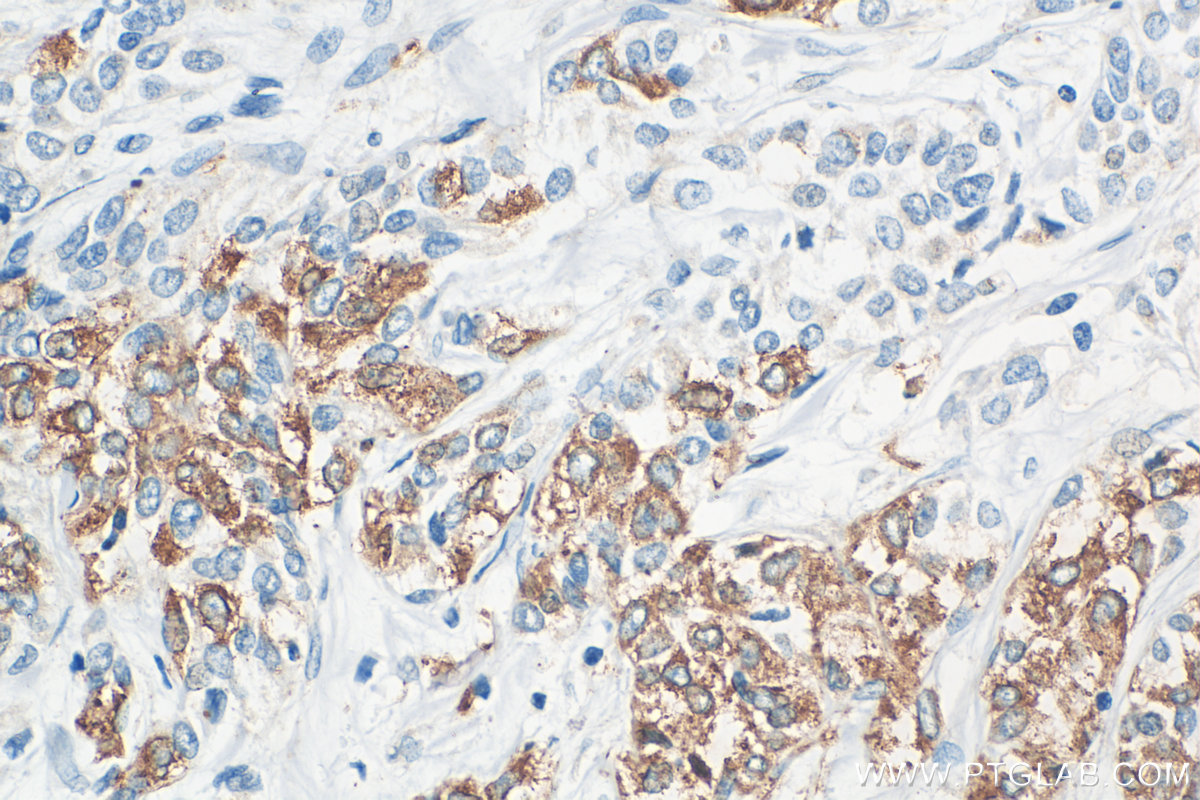 IHC staining of human urothelial carcinoma using 32382-1-AP