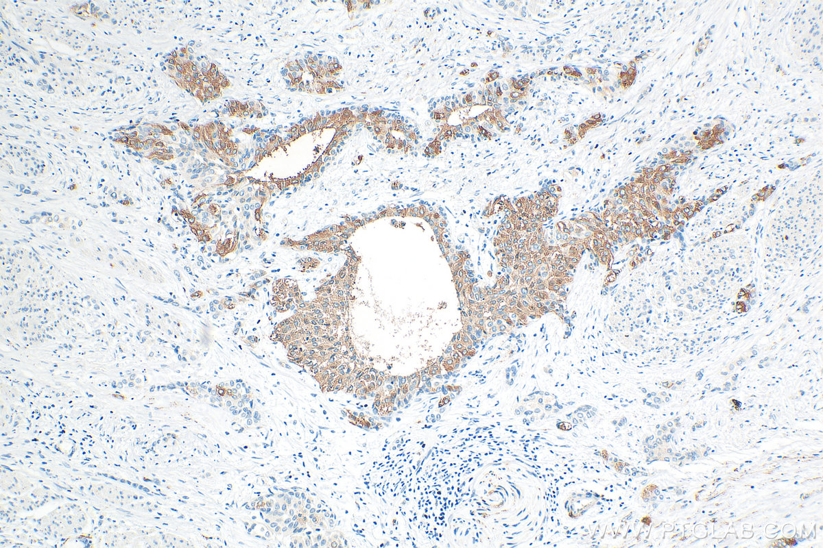 IHC staining of human urothelial carcinoma using 32382-1-AP