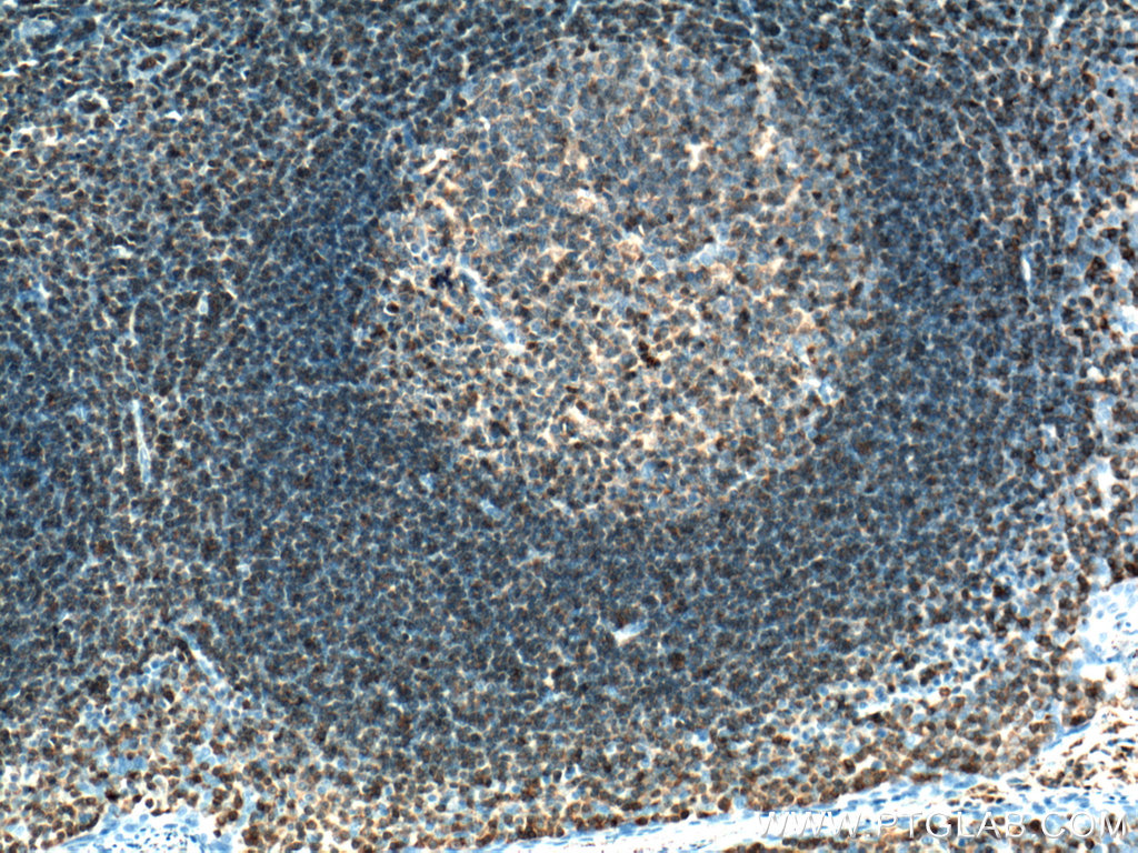 IHC staining of human tonsillitis using 66054-1-Ig