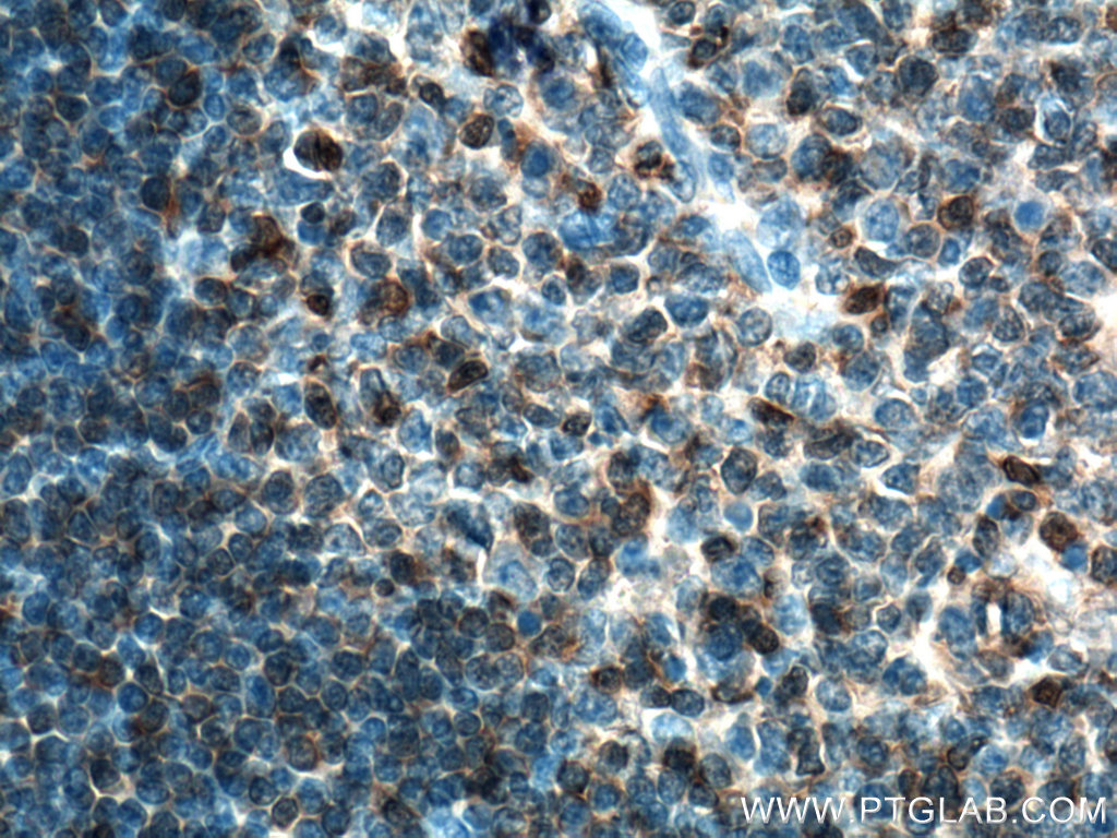 IHC staining of human tonsillitis using 66054-1-Ig