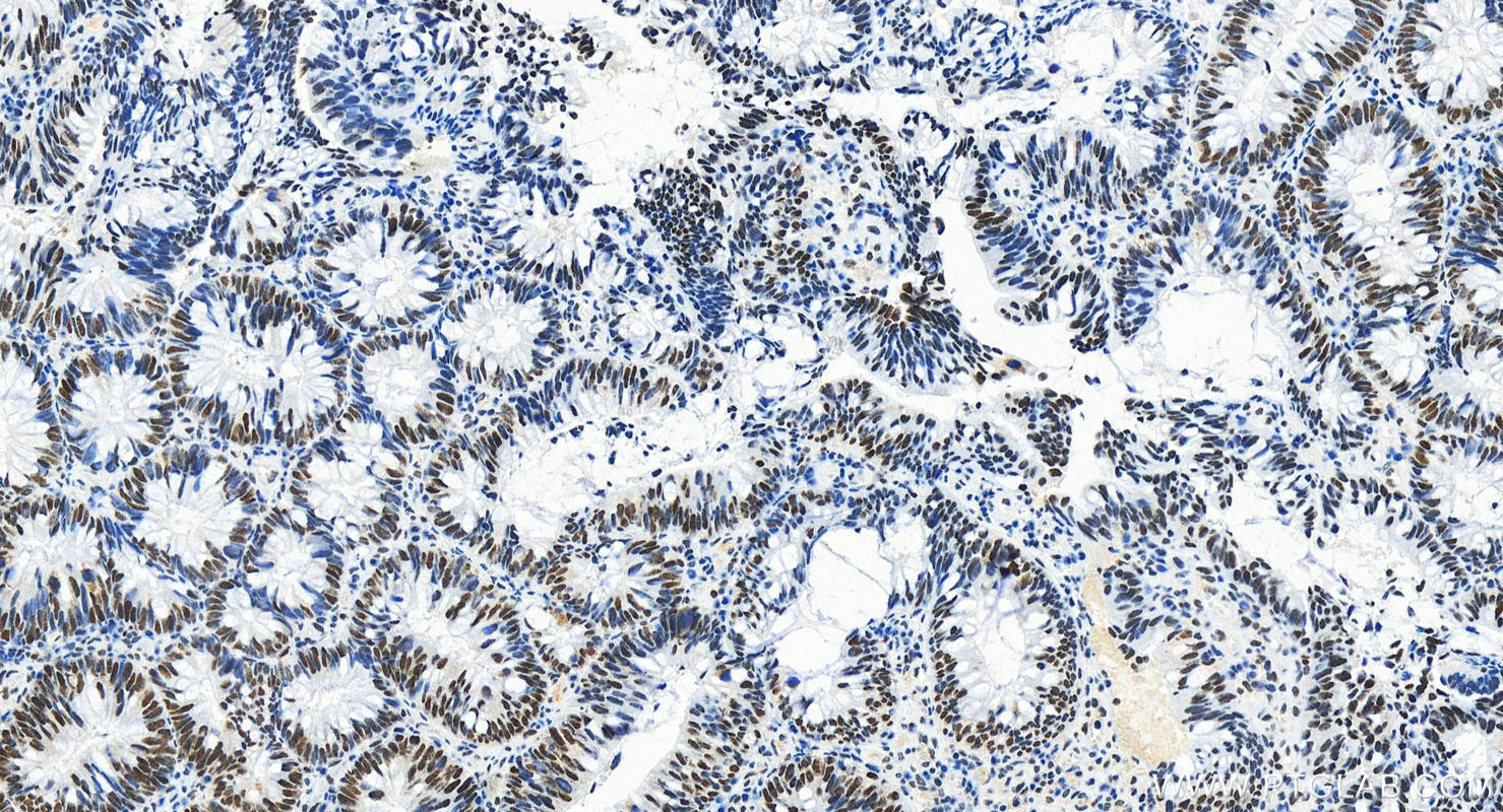IHC staining of human colon cancer using 83733-3-RR