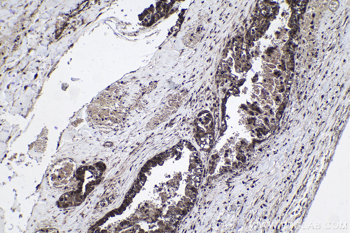 IHC staining of human pancreas cancer using 24499-1-AP