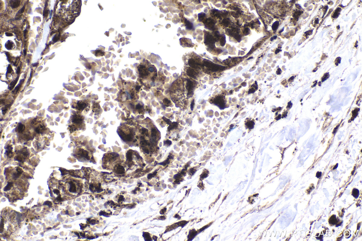 IHC staining of human pancreas cancer using 24499-1-AP