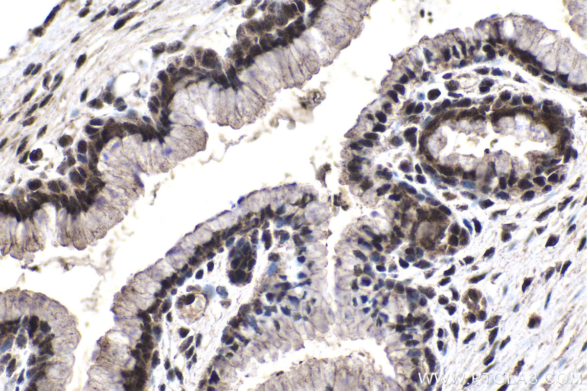 IHC staining of human cervical cancer using 24499-1-AP