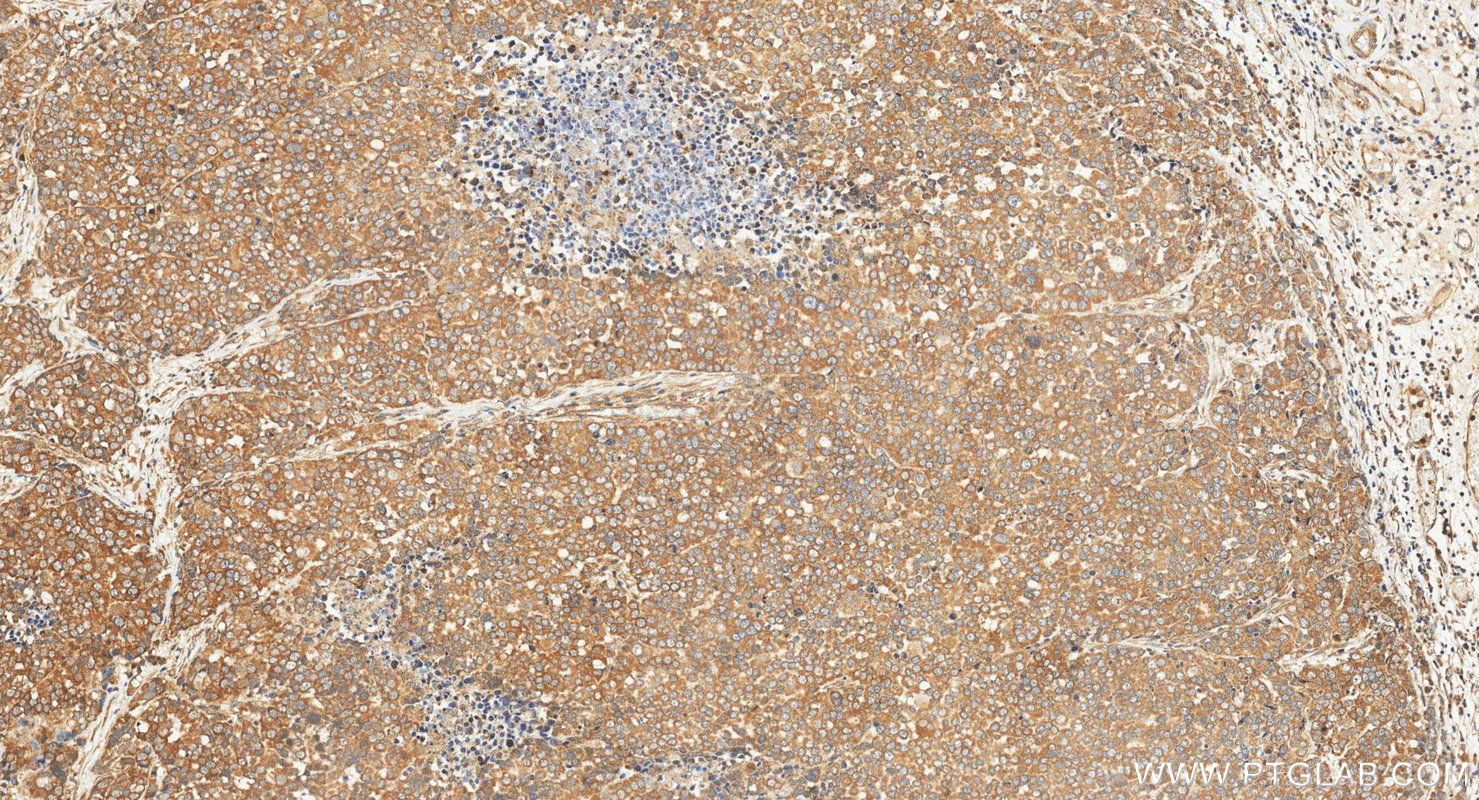 IHC staining of human ovary tumor using 10232-1-AP IHC staining of human ovary tumor using 10232-1-AP