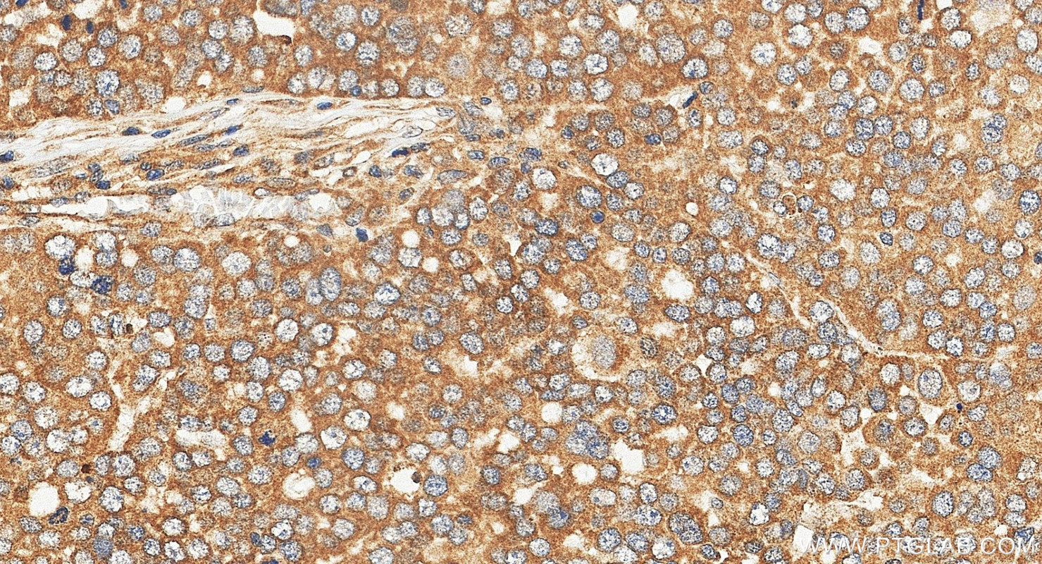 IHC staining of human ovary tumor using 10232-1-AP IHC staining of human ovary tumor using 10232-1-AP