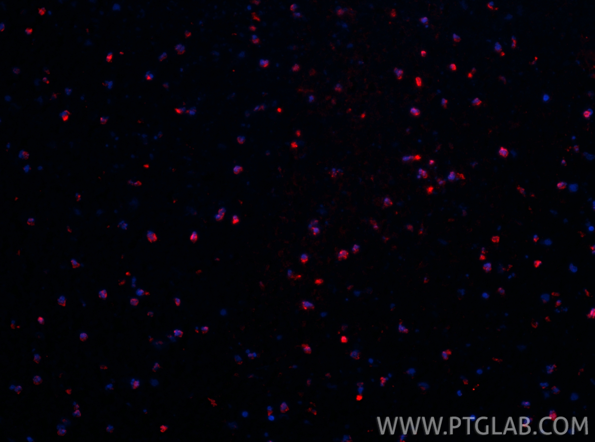 IF Staining of human ovary cancer using CL594-10232 IF Staining of human ovary cancer using CL594-10232