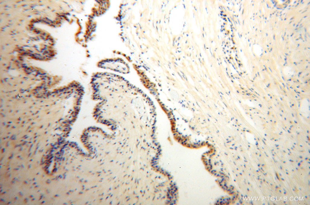 IHC staining of human gliomas using 10090-2-AP