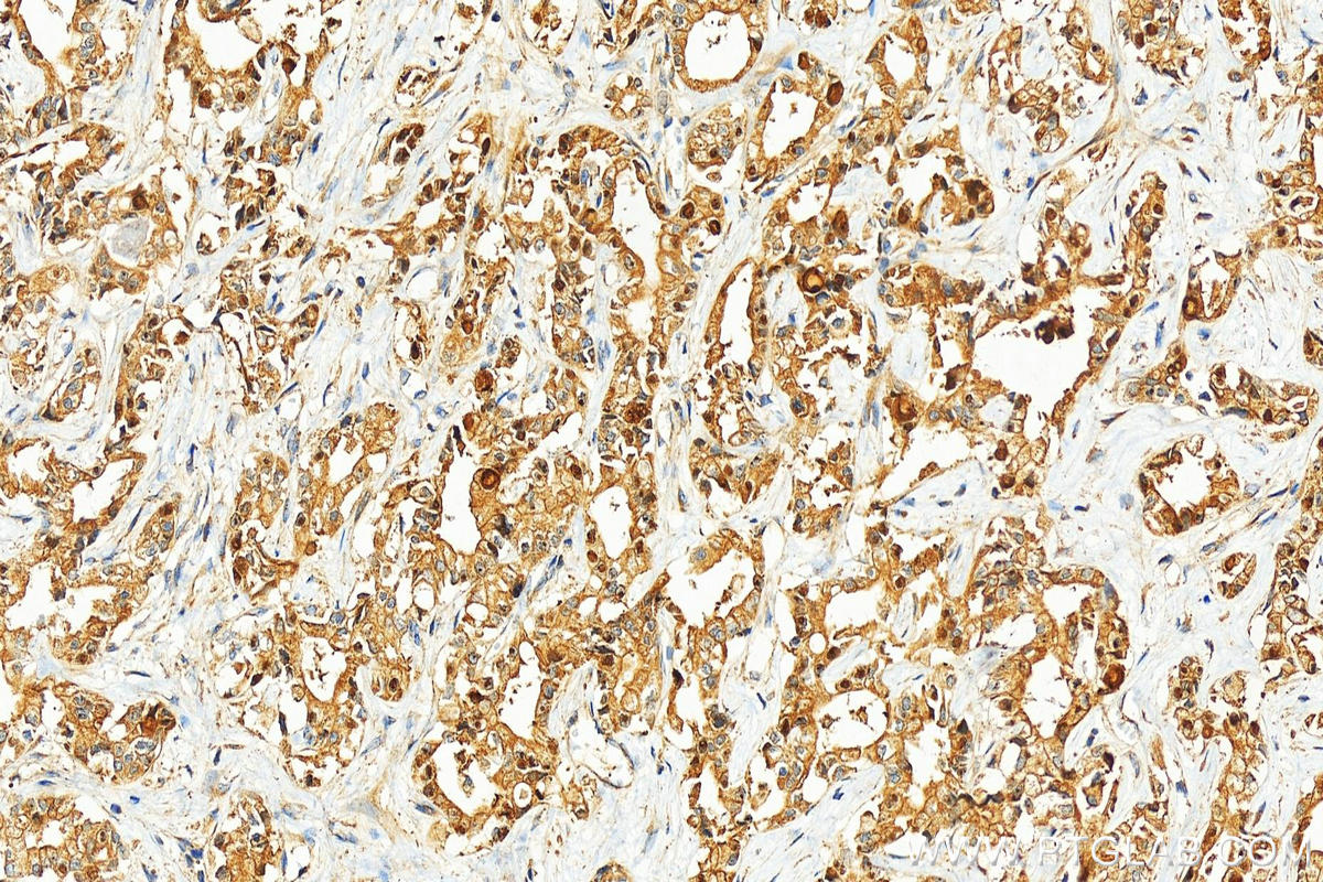 IHC staining of human intrahepatic cholangiocarcinoma using 11694-1-AP