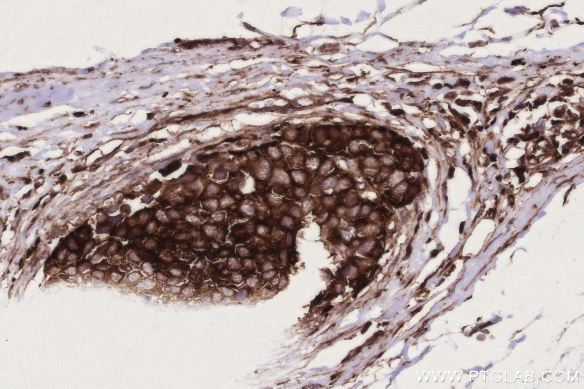IHC staining of human stomach cancer using 68186-1-Ig