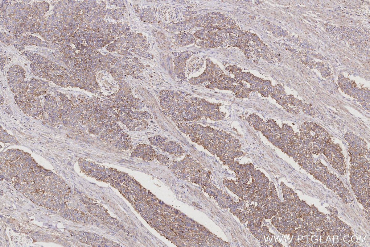 Immunohistochemical analysis of paraffin-embedded human stomach cancer tissue slide using 13049-1-AP (ARL8B antibody) at dilution of 1:500 (under 10x lens). Heat mediated antigen retrieval with Tris-EDTA buffer (pH 9.0). IHC staining of human stomach cancer using 13049-1-AP