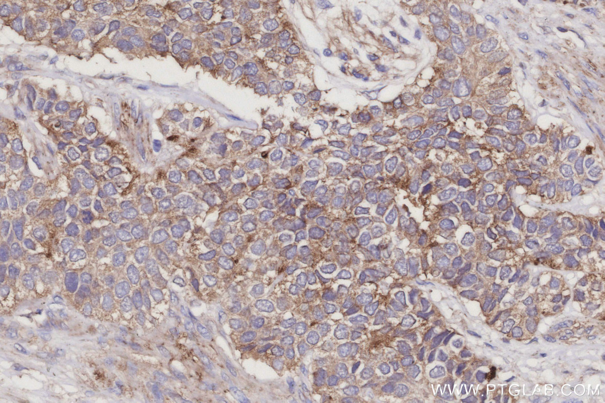 Immunohistochemical analysis of paraffin-embedded human stomach cancer tissue slide using 13049-1-AP (ARL8B antibody) at dilution of 1:500 (under 40x lens). Heat mediated antigen retrieval with Tris-EDTA buffer (pH 9.0). IHC staining of human stomach cancer using 13049-1-AP