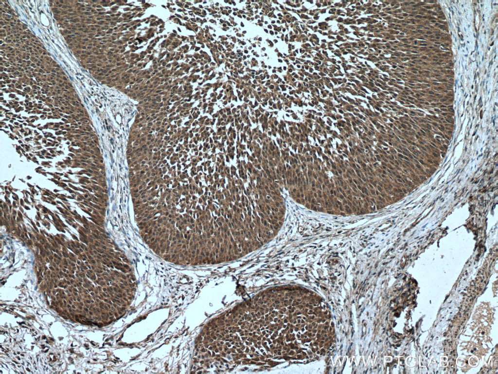 IHC staining of human cervical cancer using 12653-1-AP