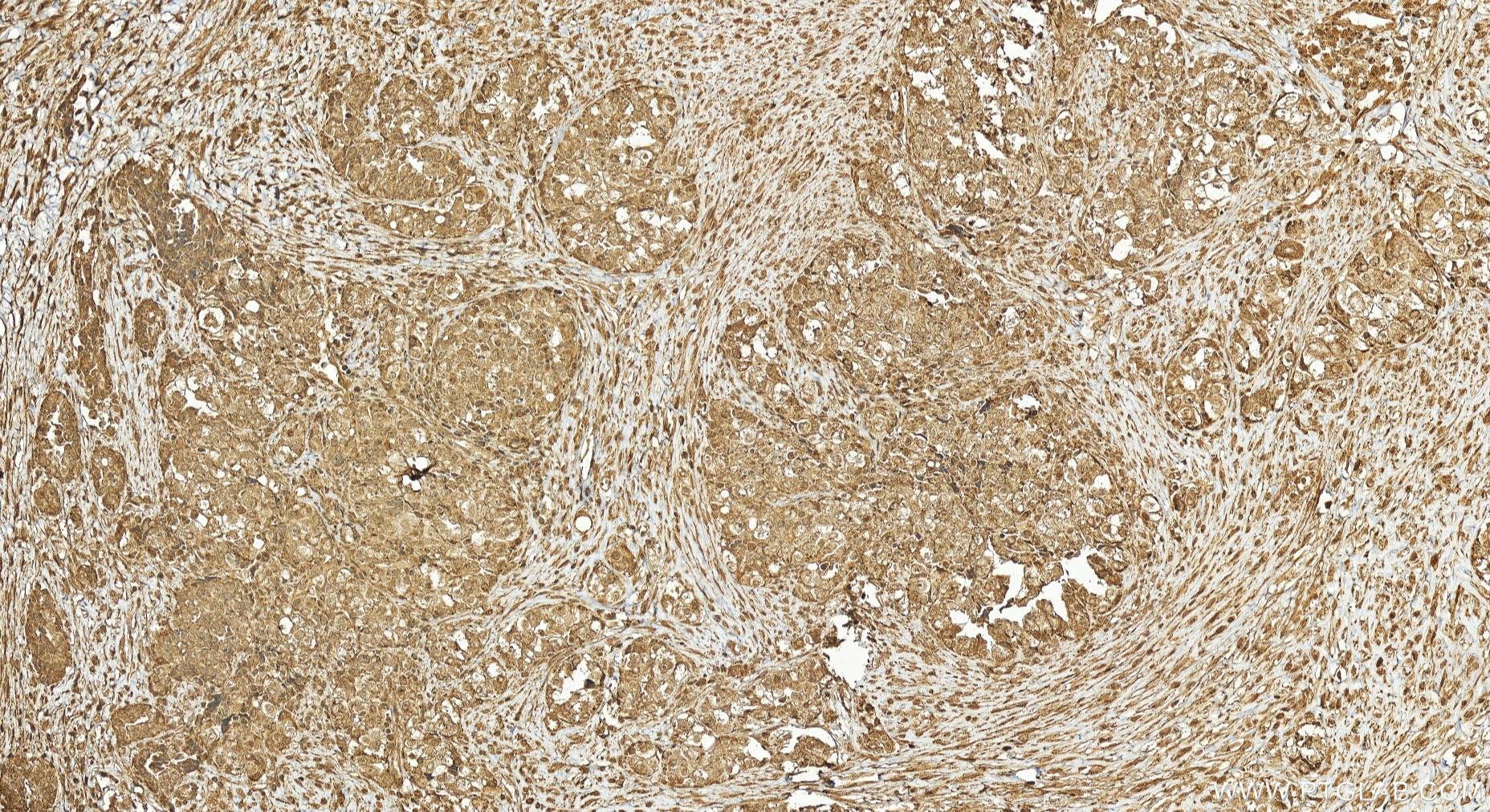 IHC staining of human ovary cancer using 25705-1-AP