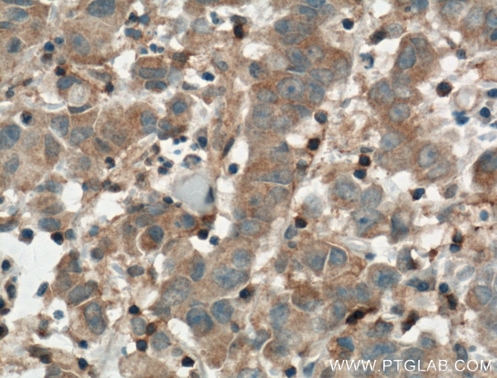 IHC staining of human prostate cancer using 14268-1-AP