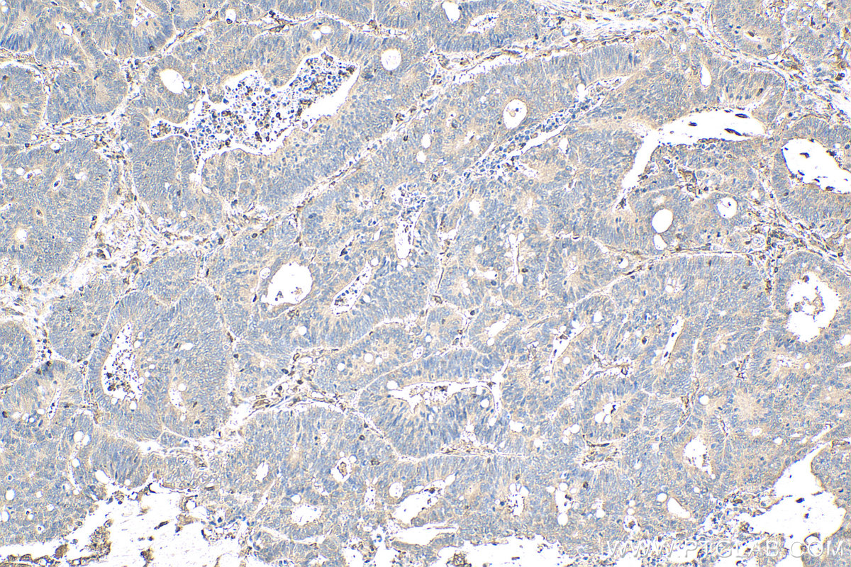 IHC staining of human colon cancer using 28368-1-AP