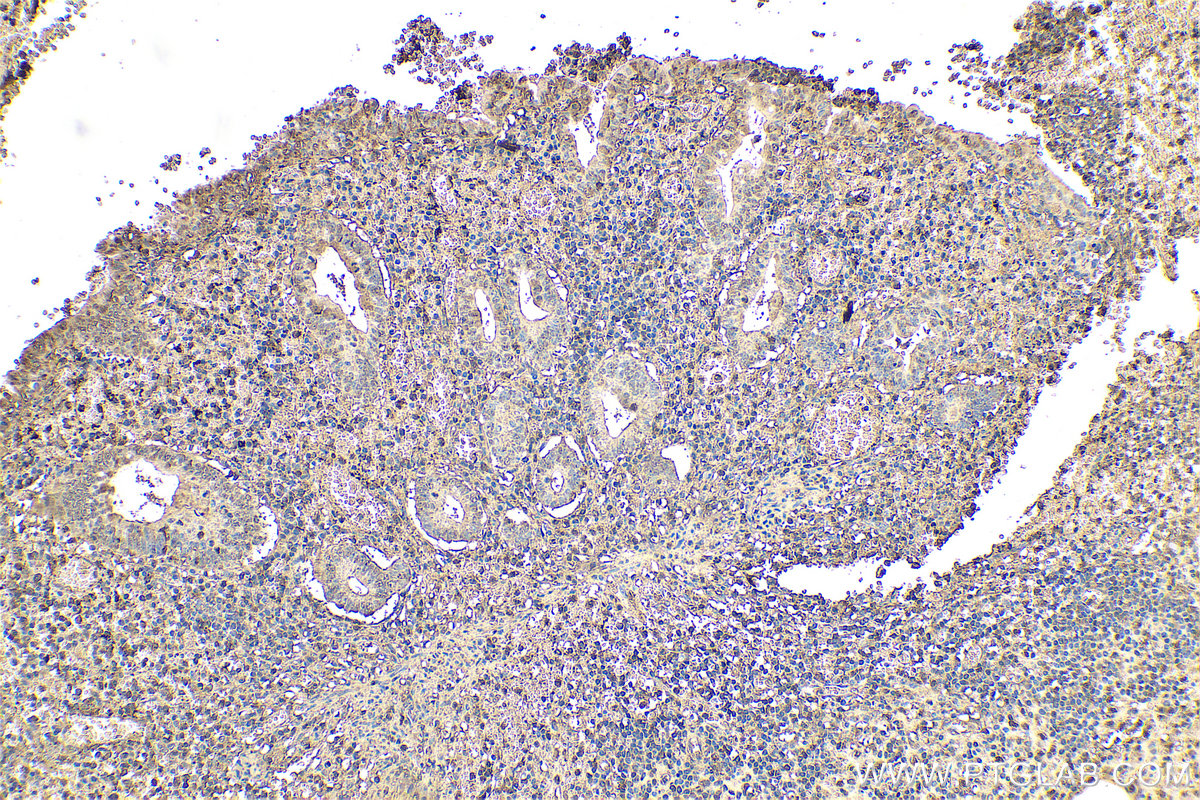 IHC staining of human appendicitis using 67320-1-Ig
