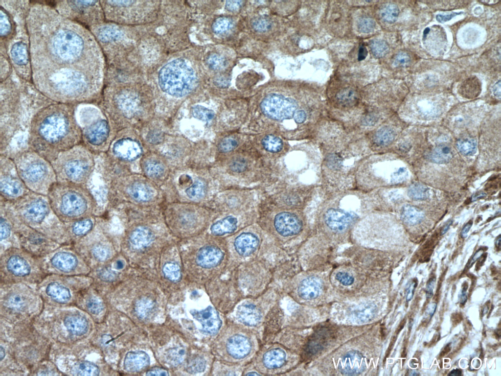 IHC staining of human breast cancer using 15058-1-AP