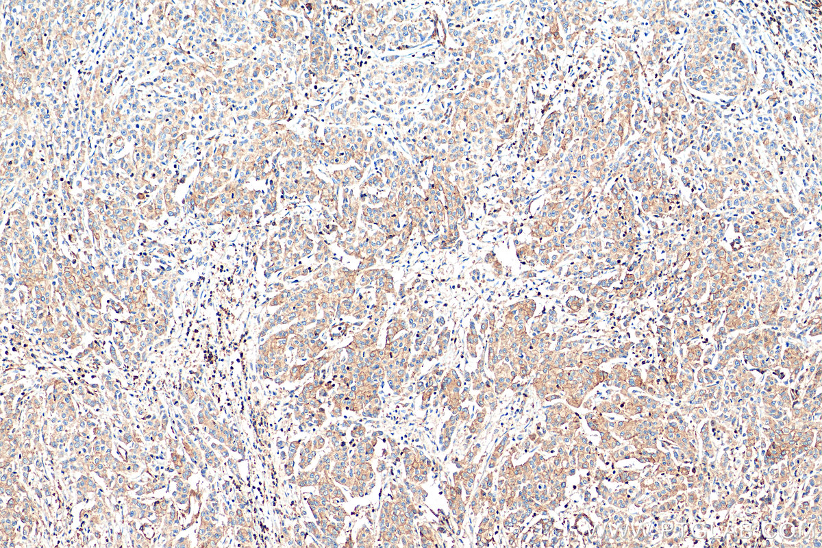 IHC staining of human stomach cancer using 68145-1-Ig