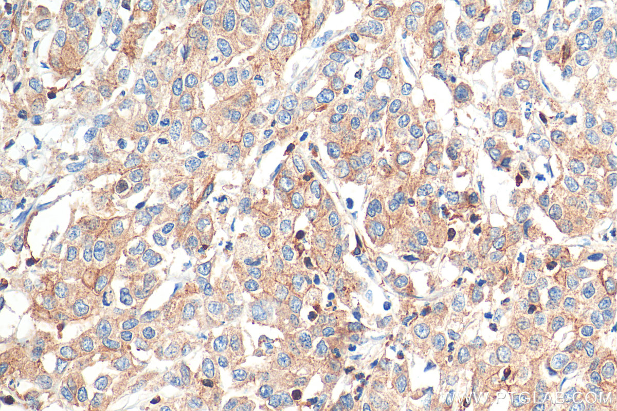 IHC staining of human stomach cancer using 68145-1-Ig