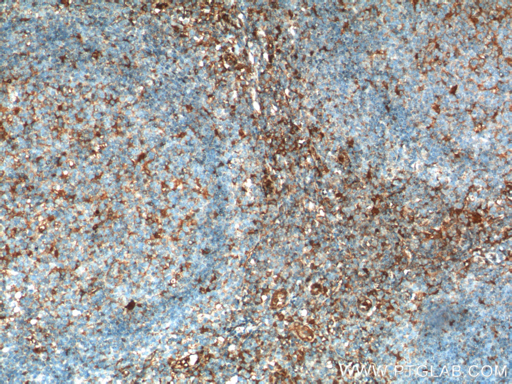IHC staining of human tonsillitis using 15361-1-AP (same clone as 15361-1-PBS)