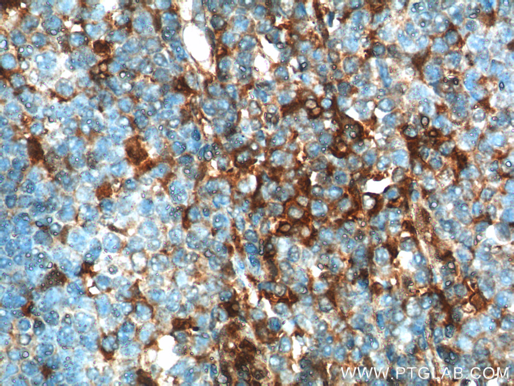 IHC staining of human tonsillitis using 15361-1-AP (same clone as 15361-1-PBS)