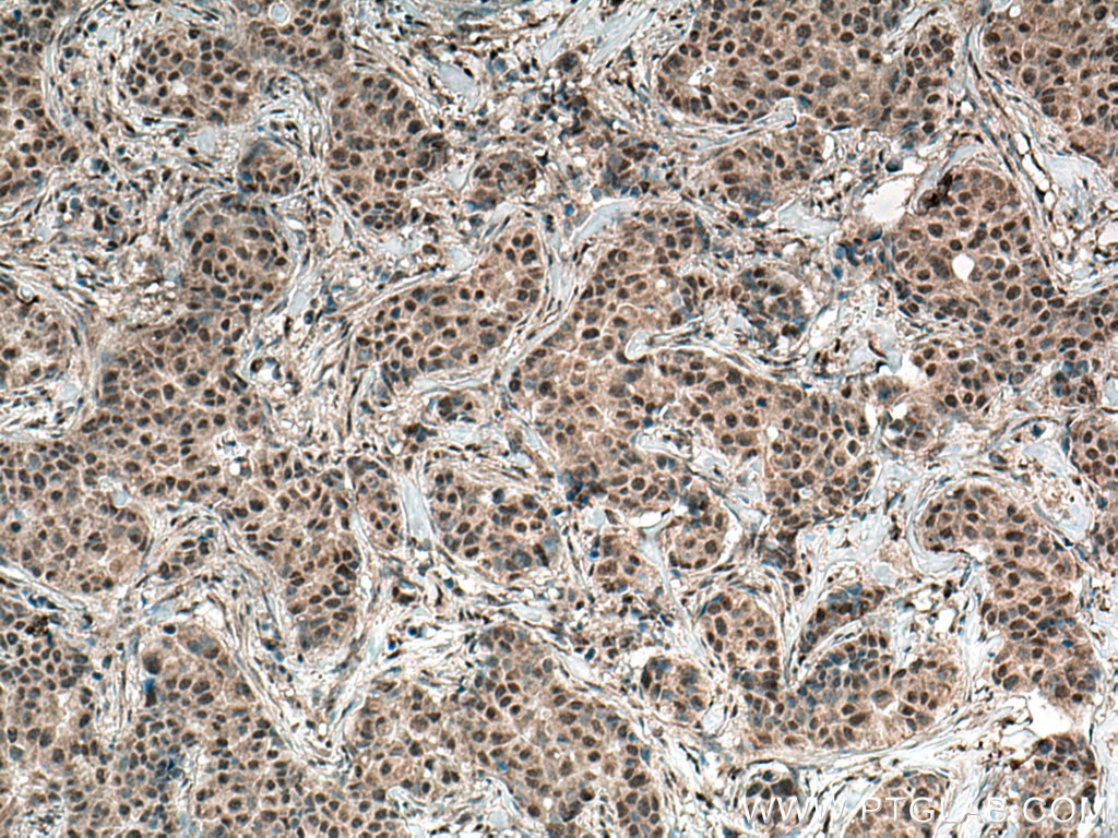 IHC staining of human breast cancer using 67092-1-Ig