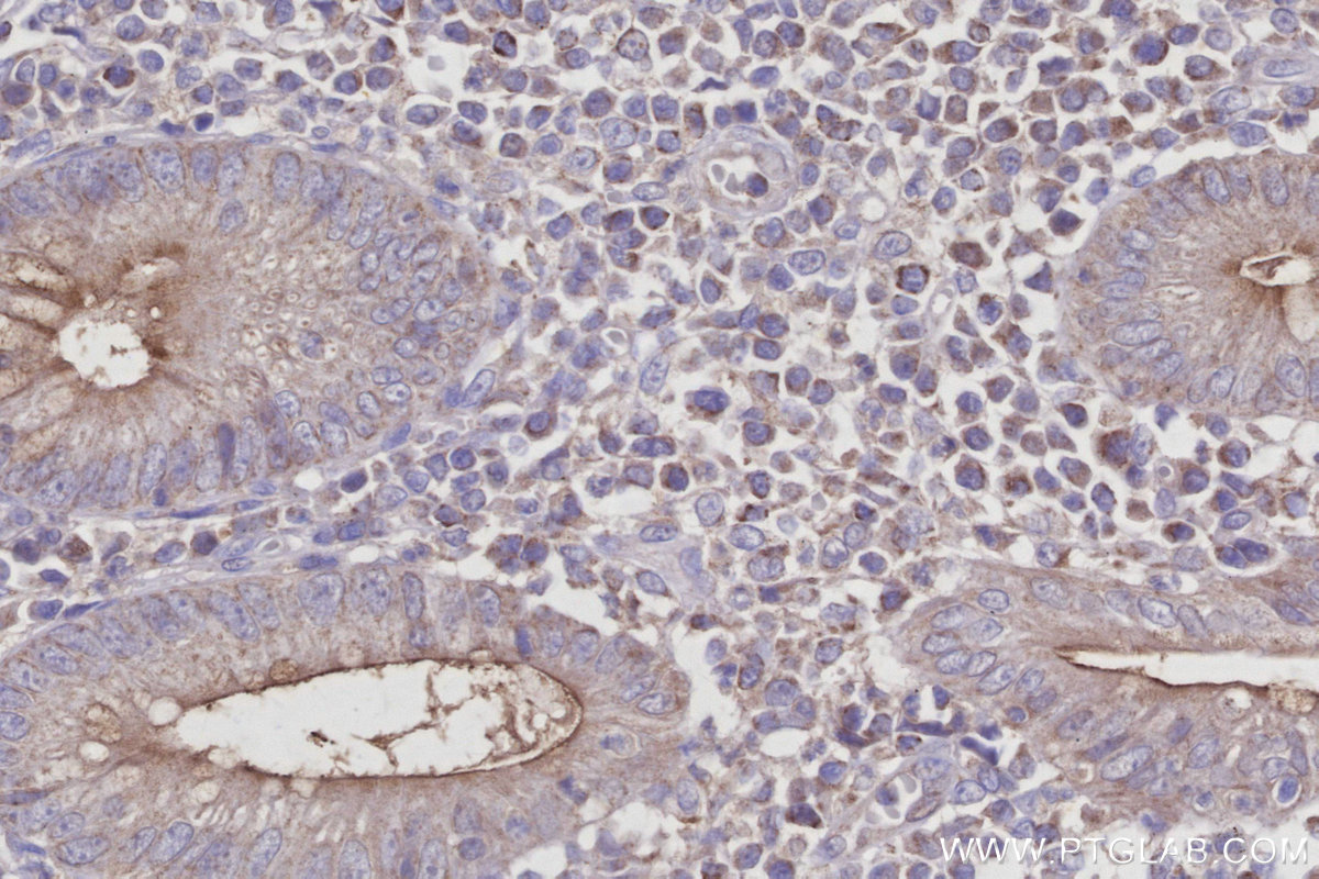 IHC staining of human appendicitis using 27742-1-AP IHC staining of human appendicitis using 27742-1-AP