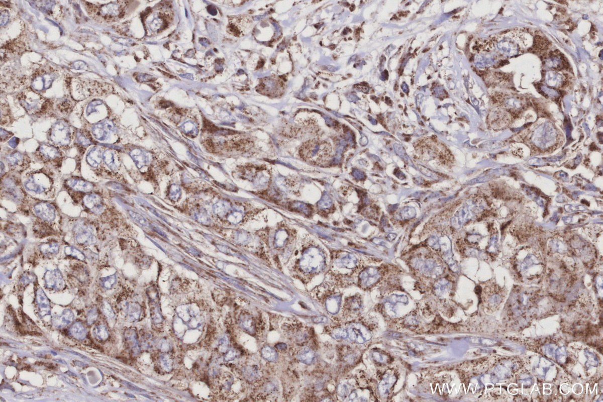 IHC staining of human pancreas cancer using 27742-1-AP IHC staining of human pancreas cancer using 27742-1-AP